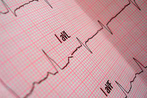 Lire la suite à propos de l’article Électrocardiogramme